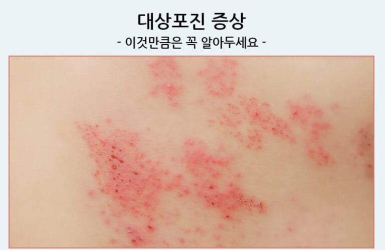 대상포진 증상: 이것만큼은 꼭 알아두세요